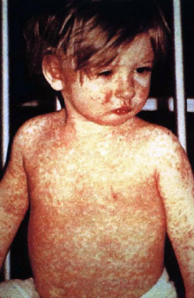 Criança com a clássica erupção de sarampo no quarto dia, em foto sem data dos Centers for Disease Control and Prevention, dos Estados Unidos.
